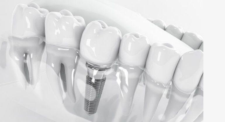 Diş İmplantı Kırıldıysa veya Diş Tedavisi Sonucu İstediğiniz Gibi Olmadıysa Tazminat Davası Açılabilir mi?