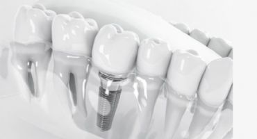 Diş İmplantı Kırıldıysa veya Diş Tedavisi Sonucu İstediğiniz Gibi Olmadıysa Tazminat Davası Açılabilir mi?